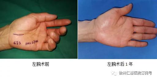  黄蜂三球接受左腕手术根治  